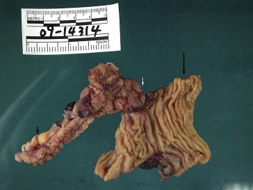 Appendix (short black arrow), fistula (white arrow), and Meckel diverticulum ...