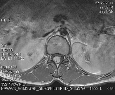 Axial T1-weighted magnetic resonance imaging with gadolinium contrast ...