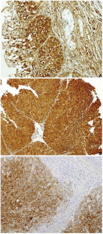 RKIP immunoexpression in normal and malignant urothelium. A, immunohistochemical ...