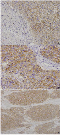 CD147, MCT1 and MCT4 immunoexpressions in urothelial bladder carcinoma. ...