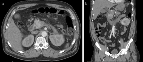 Contrast-enhanced abdominal CT – images of the lesion in the head of the ...