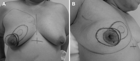 Preoperative drawings in a patient who underwent RBT (Table 2, Case 5), with the ...