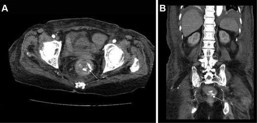 Results from computed tomography angiography (CTA) of an 84-year-old woman with ...