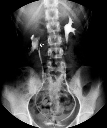 Retrograde pyelography showing right-sided hydronephrosis and ureteropelvic ...