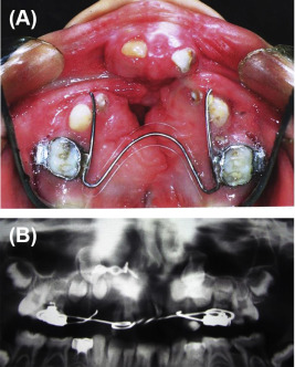 (A) Protruded premaxilla. (B) Cropped orthopantomograph (OPG) after premaxillary ...