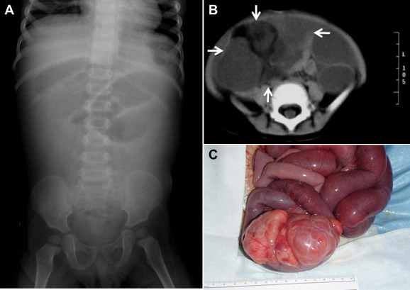 (A) Abdominal plain X-ray demonstrated small bowel obstruction. (B) Abdominal ...