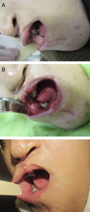 (A) Vertical scar band in buccal mucosa. (B) Multiple z-plasty flaps. (C) Result ...