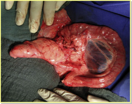 The implanted pancreas graft 10 minutes after reperfusion.22