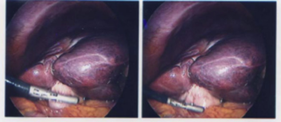 Intraoperative laparoscopic view of gallbladder.