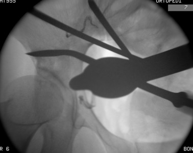 The first osteotomy on the supra-acetabular region. From medial to lateral ...