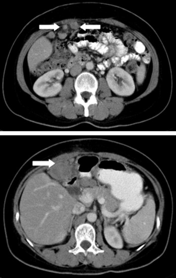 A metastatic peritoneal sarcomatoid carcinoma identified by abdominal computed ...