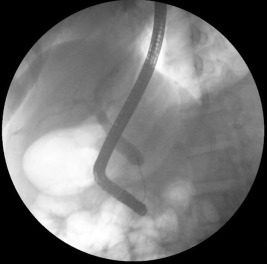 Cholangiopancreatography shows absence of distal common bile duct (CBD).