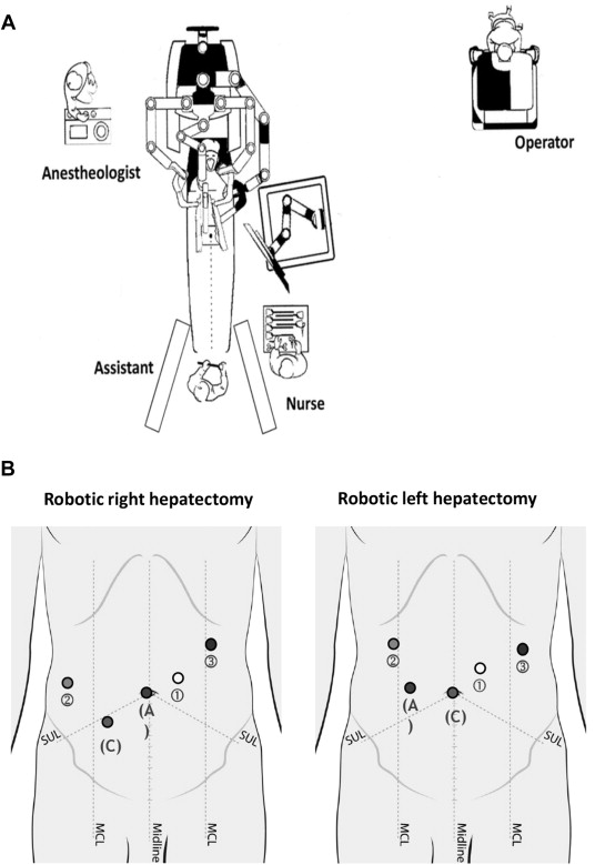 (A) Typical operating room set up for robotic hepatectomy. (B) Port placements ...