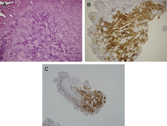 (A) Diffuse neoplastic lymphoid cells infiltrated in the mucosa of the duodenal ...