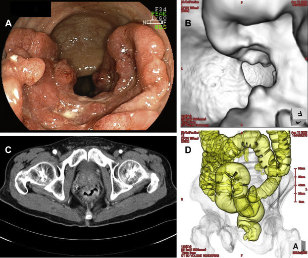 (A) Colonoscopy image of a tumor with 60% circumferential extent. (B) Computed ...