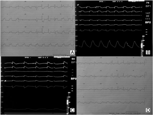 The admission twelve-lead electrocardiogram showed an ST elevation in inferior ...