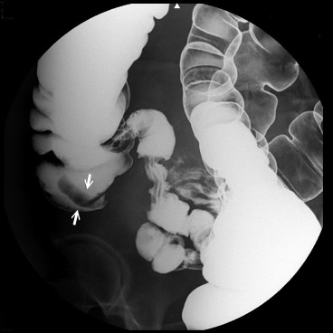 Lower gastrointestinal series using barium contrast revealed a tubular filling ...