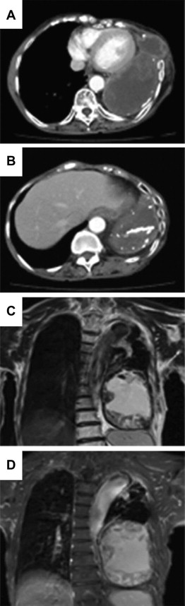 (A) Chest CT revealed a huge mass beyond the left thorax; (B) calcification was ...