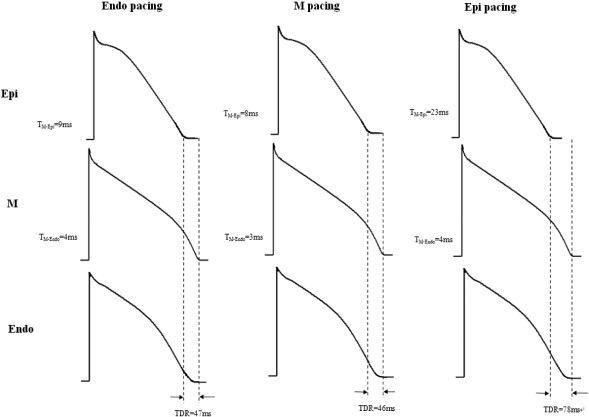 Effect of endocardial, mid-myocardial, and epicardial pacing on transmural ...