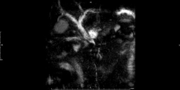 Recombinant MR image showing mild dilatation of both lobes' IHDs, CHD, and CBD, ...