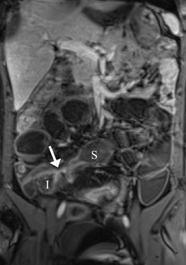 A 25-year-old man. Coronal postcontrast VIBE image shows affected tethering ...