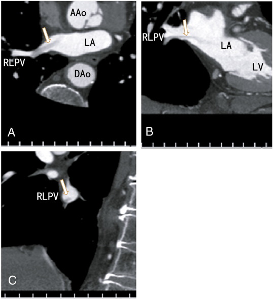 A: Axial images showing a thrombus in the right lower pulmonary vein with no ...