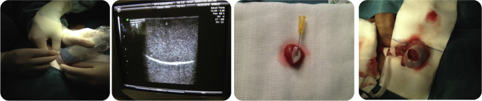 Orquidectomia parcial ecoguiada.