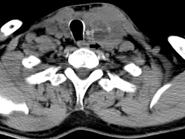 A mass lesion in the left thyroid lobe invaded the carotid artery (black arrow), ...