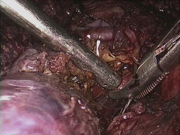 Checking the bile duct orifices with a biliary probe.
