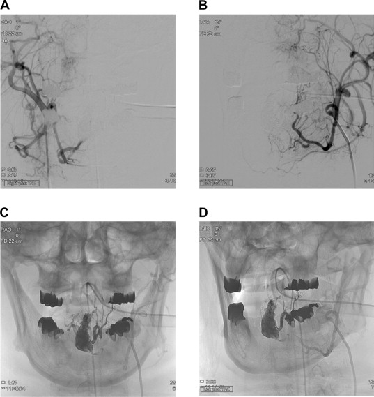 Bilateral external-carotid angiogram obtained immediately after embolization ...