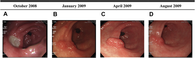 Case 4. A 59-year-old woman had GI bleeding. The EGD showed gastric ulcers in ...