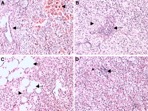 Microscopic appearances of hepatic perivascular epithelioid cell tumor. (A) ...