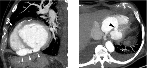 Maximum intensity (MIP) CT image of the heart in sagittal (A) and axial oblique ...