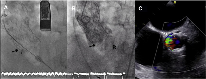 (A) Bulky calcification in non-coronary sinus (asterisk) where de valve frame is ...