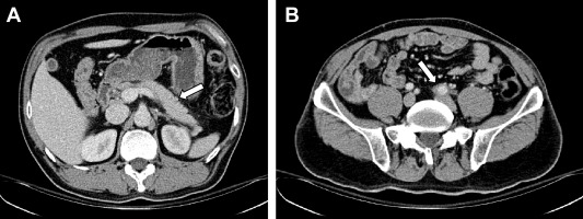 After 3 months of treatment, enhanced computed tomography shows (A) a decrease ...