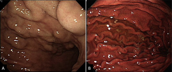 Esophagogastroduodenoscopy before and after splenectomy. (A) Prominent gastric ...