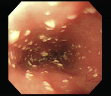 Endoscopic images of esophageal candidiasis showed that whitish plaques were ...