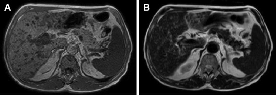 Magnetic resonance imaging shows multiple tiny tumors, which are (A) hypointense ...