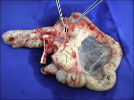 An explanted pancreas with the prepared vessels (a = aortic graft; b = portal ...