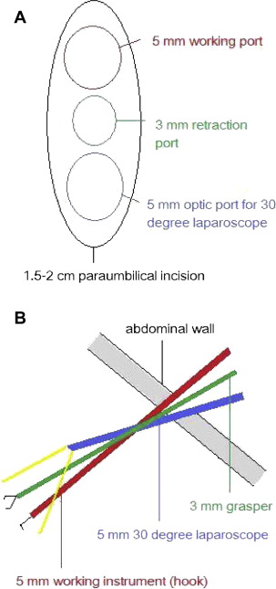(A) The skin incision and port insertions during a single-incision laparoscopic ...
