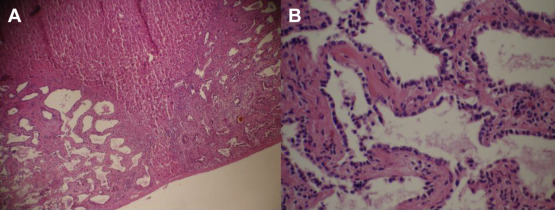 Histopathology of the biopsy shows (A) multiple dilated and disorganized bile ...
