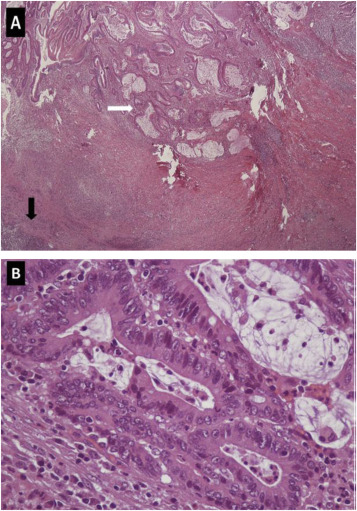 (A) Irregular glands with stromal invasion to muscularis propria noted under H&E ...