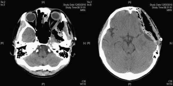 (Left) Postoperative plain computed tomography of the brain showing good ...