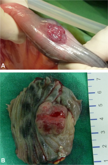 (A) On laparoscopic exploration, the lesion is identified as a vascular bulge at ...