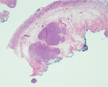 Photomicrograph of the resection specimen showing nests of pancreatic tissue ...