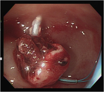 Endoscopic view after injection and application of an endoloop using the ...