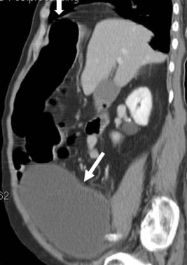 Sagittal reformatted contrast enhanced abdominal computed tomography shows the ...
