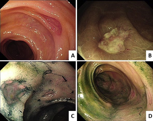 (A) Single-balloon enteroscopy shows multiple 0.3–1.0-cm discrete ulcers ...