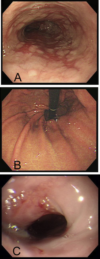 Endoscopic pictures of an 86 year-old woman. (A) Before percutaneous endoscopic ...