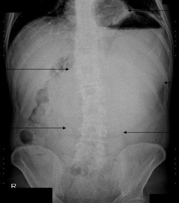 Upright abdominal X-ray of the patient illustrating a dilated stomach and ...